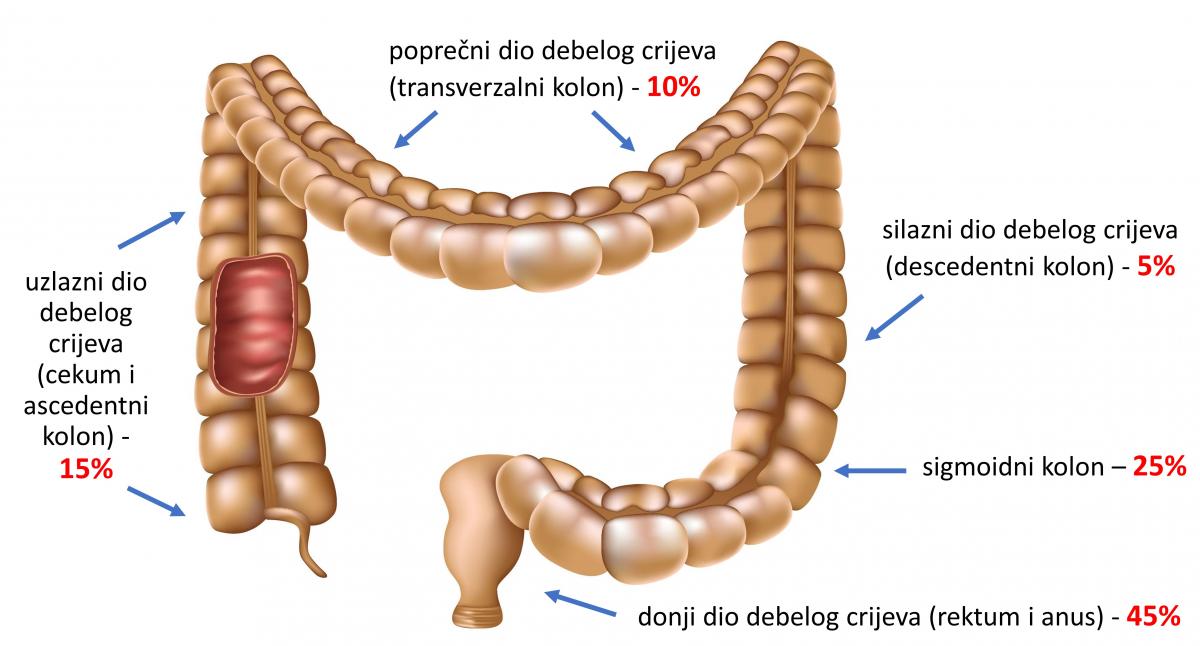 Rak debelog crijeva | | ZZJZDNZ.HR