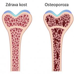 Osteoporoza - tiha epidemija