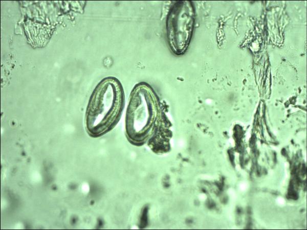 enterobius vermicularis na urina