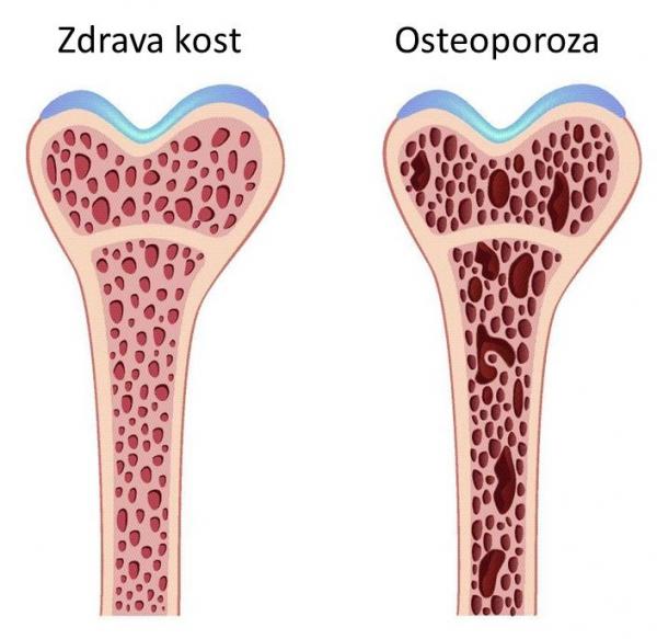 Razlika između osteoporoze i osteomalacije